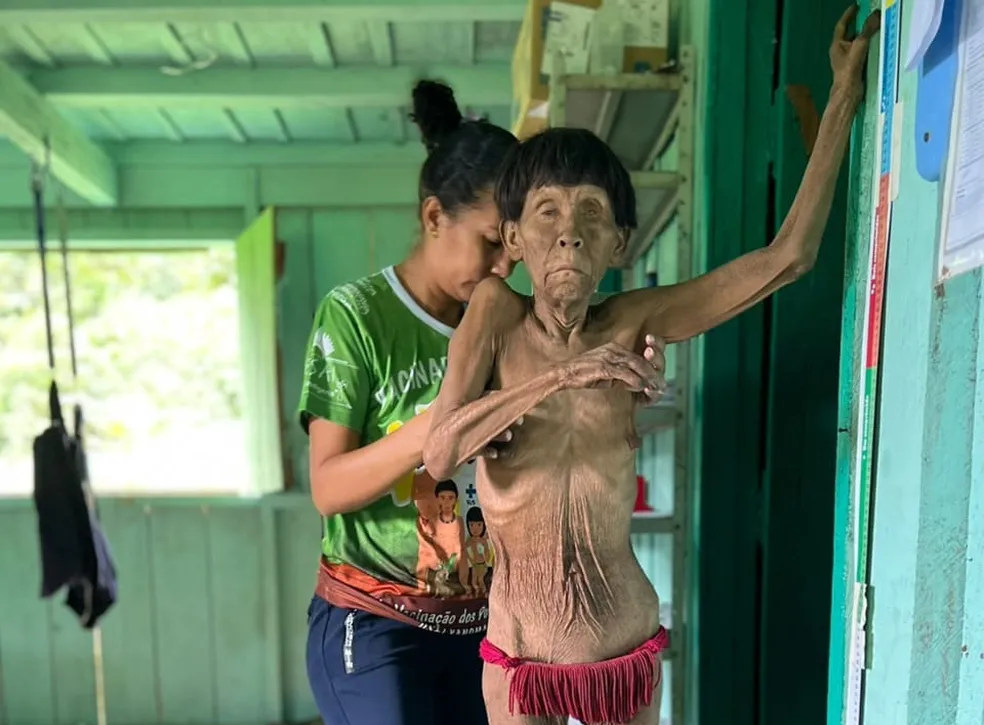 Abandono: Com a invasão do garimpo e sem assistência de saúde, Yanomami sofrem com desnutrição aguda